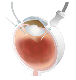 硝子体手術の例