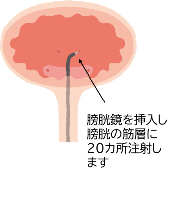 ボトックス膀胱壁内注入療法