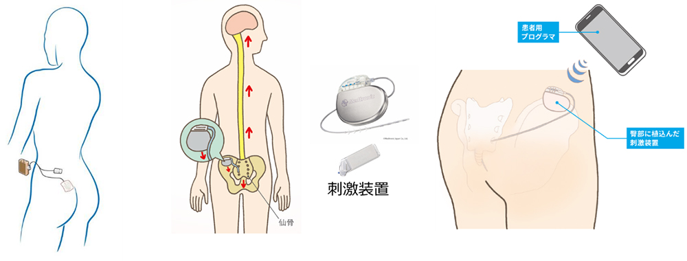 仙骨神経刺激療法